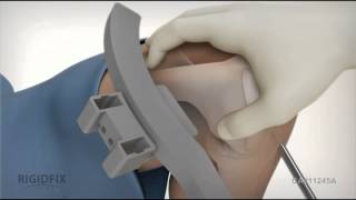 RIGIDFIX Curve Surgical Tech Full Animation