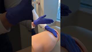 How to properly perform a ventrogluteal injection.