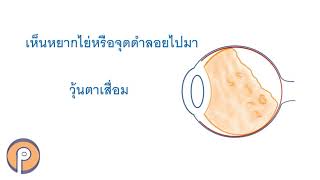 วุ้นตาเสื่อม - อาการ เห็นหยากไย่ หรือจุดดำลอยไปมา #วุ้นตาเสื่อม