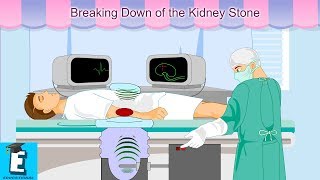 Breaking Down of the Kidney Stone Learn for Children and Kids | EDUKID Learning