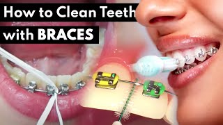 Braces Care Routine | Water Flosser, Brushing, Rinsing etc.