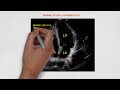 Key differences between the left and right ventricles on apical 4 chamber view I POCUS I Echo