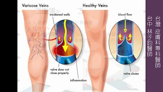 靜脈曲張的治療方式-極緻美型·文心極緻皮膚科診所整形手術-林子鈞醫師：靜脈曲張_台中靜脈曲張_硬化劑_雷射治療_注射治療