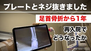 足首骨折から1年【抜釘手術】金属板とネジを抜く