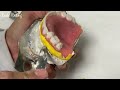 relining a loose denture full process