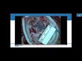 neurosurgical techniques and maximizing safe resection ucla brain tumor virtual conference 2022