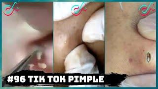 #96 TIK TOK PIMPLE VIDEO COMPILATION US UK | 5th September 2020