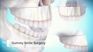 Gummy Smile Surgery