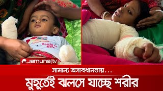 সামান্য অসর্তকতায় মুহূর্তেই ঝলসে যাচ্ছে শরীর; সচেতনতার তাগিদ | Awareness