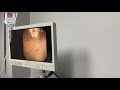 bladder botox injection procedure desert sky urology by dr. lauren byrne md