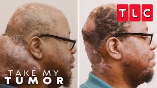 Arlin Finds Peace and Relief With Out His Tumor | Take My Tumor | TLC
