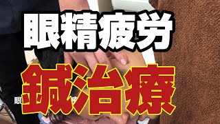 眼精疲労に鍼治療|眼窩内刺鍼