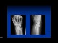 nonoperative treatment of distal radius fractures michael bednar md