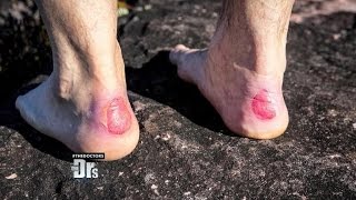 Drs. Rx: How to Avoid Getting Blisters on Your Feet!