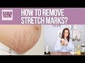 Remedies for Stretch Marks | Post Pregnancy Stretch Marks | Remove Stretch Marks | Juggun Kazim