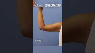 Arm Liposuction | Arm Fat Reduction #weightloss #exercise #skintones #muscletone