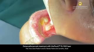 Osteoradionecrosis treatment with LiteTouch™ Er:YAG laser