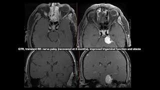 Combined Transpetrosal Approach for Recurrent Petroclival Meningioma