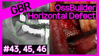 [Online Surgery] Placing Implants at 43, 45, 46 Using OssBuilder