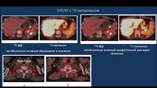 Ходжибекова М.М. «Роль ПЭТ/КТ в диагностике неходжкинских лимфом»