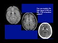 imaging of bilateral basal ganglia and thalamic diseases