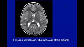 Imaging of Bilateral Basal Ganglia and Thalamic Diseases