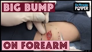 An interesting bump on the forearm