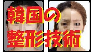 【驚愕】韓国の整形技術「BeforeAfter」もはや別人！