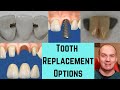 5 ways to replace a missing front tooth.