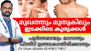 How to get rid of pimples in face / pimple marks on shoulders and back naturally in malayalam