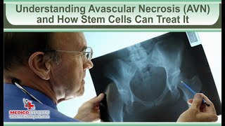 Understanding Avascular Necrosis AVN and How Stem Cells Can Treat It