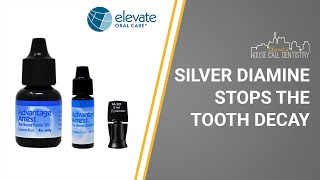 Silver Diamine Stops the Tooth Decay