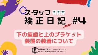 【スタッフ矯正日記#4】下の抜歯と上のブラケット装置の装着について｜山口県宇部市「歯科・矯正歯科アールクリニック」