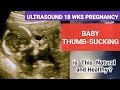 Ultrasound 18wks Pregnancy Baby Thumb Sucking