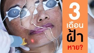 รักษาฝ้า | EP.6 | ฝ้า หน้าเป็นฝ้า เดินทางบินไกลจากเยอรมัน เพื่อมารักษาฝ้าที่นี่ | BSL Clinic