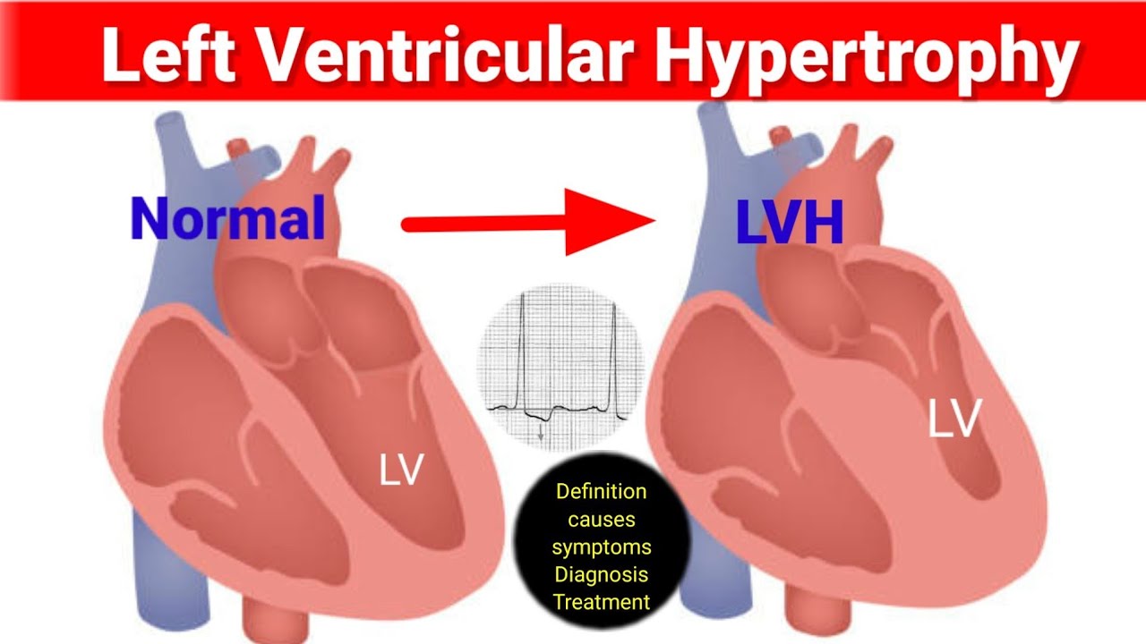 Left Ventricular Hypertrophy Lvh Causes Symptoms And 56 Off