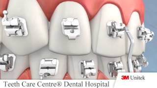 Why 3M Orthodontic Self Ligating Braces Treatment - Best Orthodontist Ahmedabad