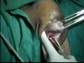 LARGE VULVAL CYST EXCISION operation