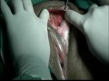 LARGE VULVAL CYST EXCISION operation