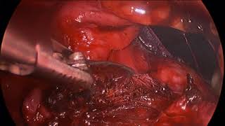 vNOTES after Cesarean Section -- Pre-Operative Diagnosis \u0026 Technique to Release Anterior Adhesions