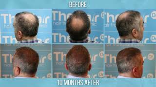 Crown-only FUE Hair Transplant by Dr Arshad