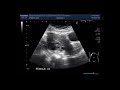 Ultrasound Video showing Two cases of uterine masses, Fibroids.