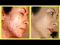 How to Remove Pimples Overnight || Acne Treatment || Ankita Beauty Beats