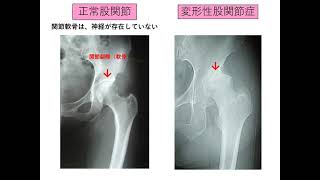 エクササイズで改善する股関節痛（診断編）