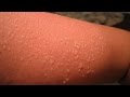 How to get Rid of Sunburn Blisters | sunburn treatment How to get Rid of Sunburn Blisters | sunburn treatment
