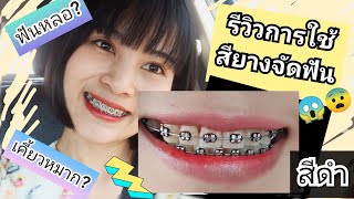 รีวิวการใช้สียางจัดฟันสีดำ ฟันหลอ?เคี้ยวหมาก? :คุยเฟื่องเรื่องจัดฟัน EP.5