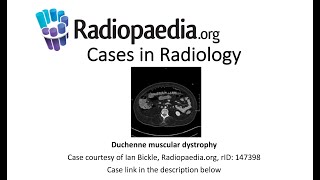 Duchenne muscular dystrophy (Radiopaedia.org) Cases in Radiology