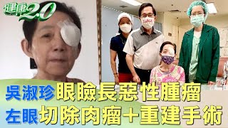 吳淑珍眼瞼長惡性腫瘤 左眼切除肉瘤加重建手術 健康2.0 @tvbshealth20