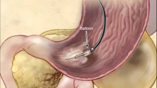 Infected Necrotizing Pancreatitis - Treatment By Endoscopic Transgastric Necrosectomy