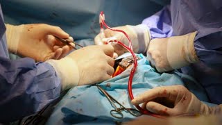 How Does Heart Bypass surgery work? coronary artery graft procedure.